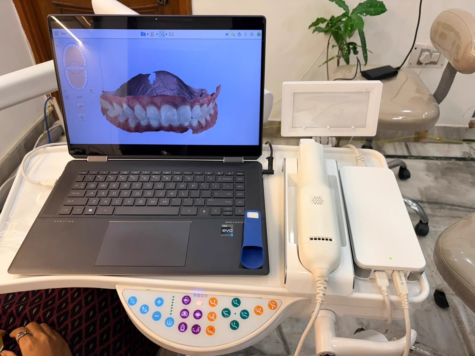 iTero Element intraoral scanner displaying a 3D scan of a patient's teeth